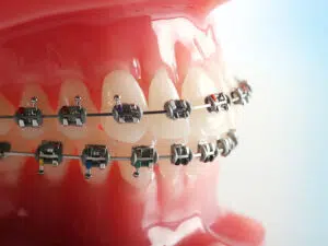 Mt Kisco Braces