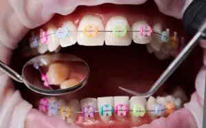 Tooth decay with braces