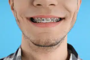 Invisalign vs. Braces