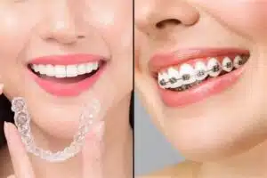 Aligners Vs Braces