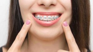 Braces treatment for adults