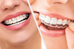 Braces-Vs-Invisalign