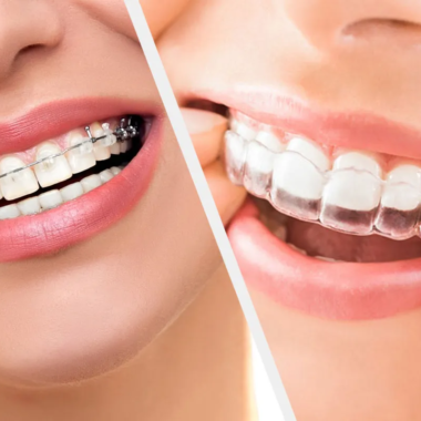 Braces-Vs-Invisalign