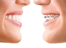 Invisalign Braces