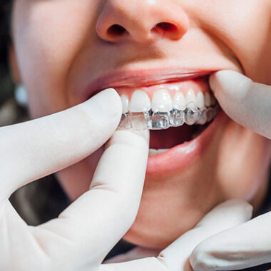 Invisalign Treatment Transfers