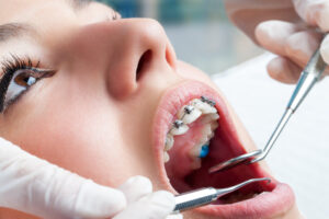 Braces treatment for adults